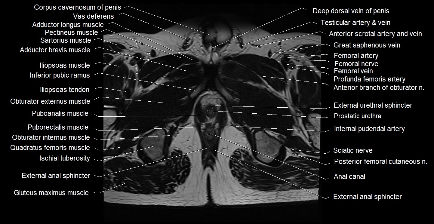 Male pelvis axial cross sectional anatomy image 39.webp